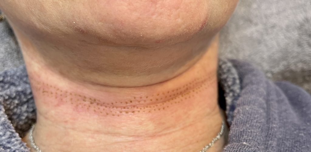 Plasma pen treatment on neck