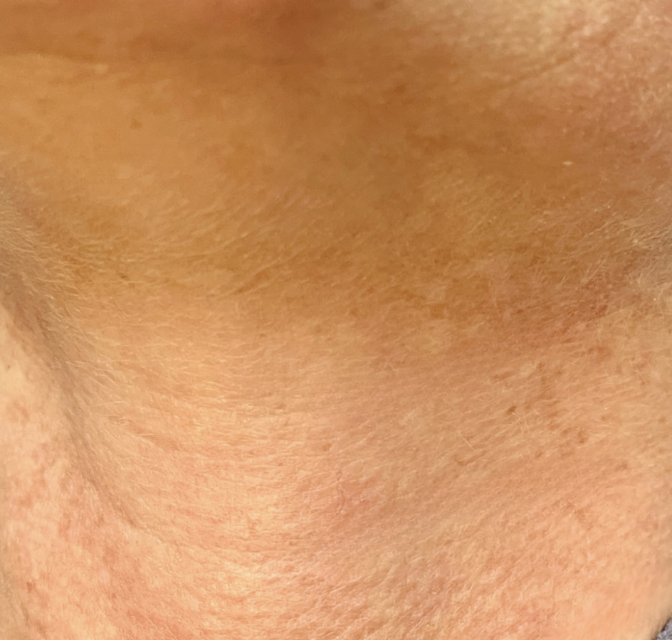 6 months after skin pen treatment