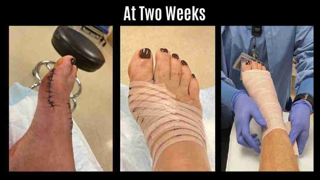 My bunion surgery at two weeks