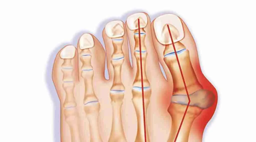 Image of a bunion on a foot
