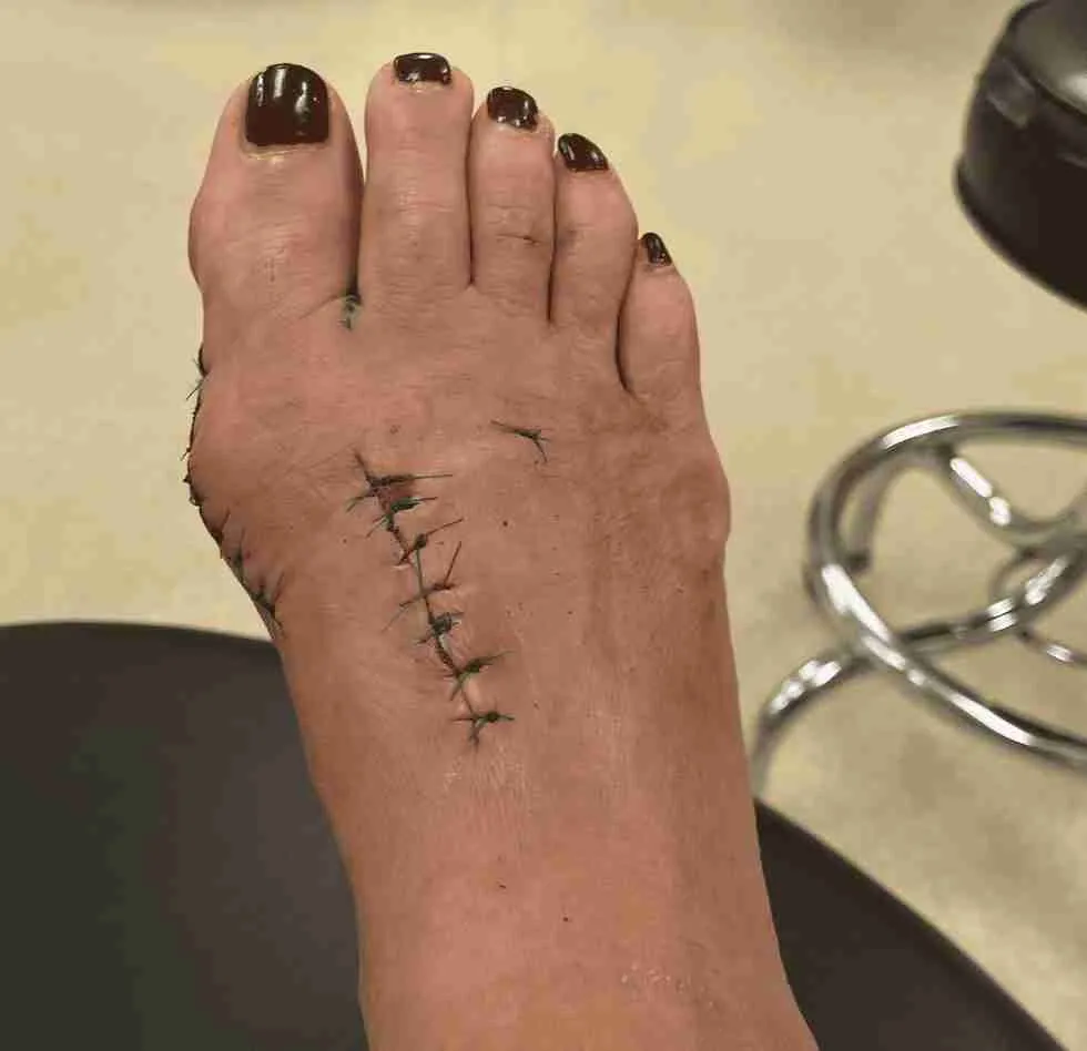 Bunion Surgery Stitches on Foot