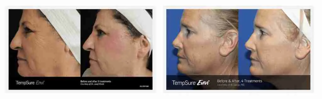 Tempsure Envi Before and After 