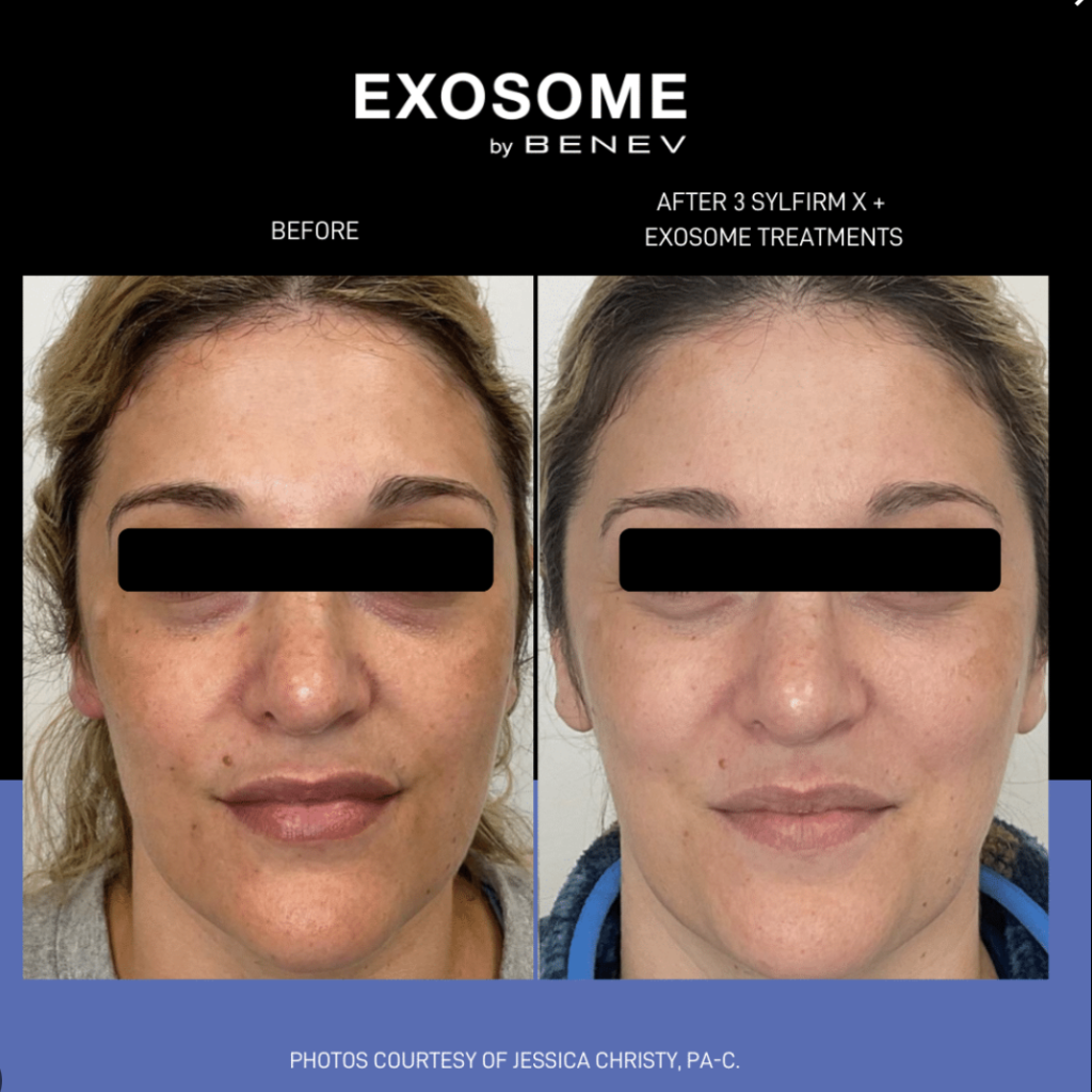 Exosome by Benev before and after photos 