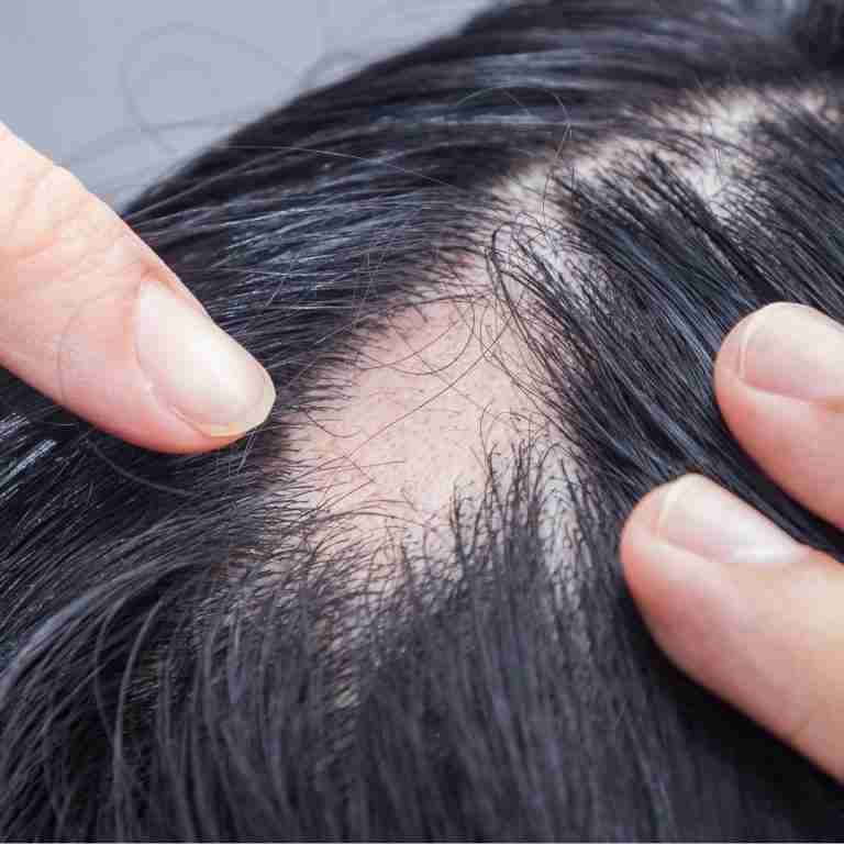 Hair loss causes in women-symptoms-treatments-prevention – Gal Pal ...