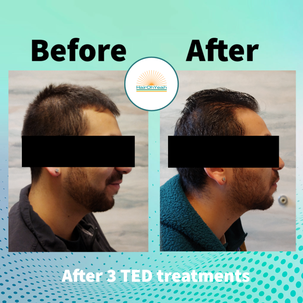 Hair restoration treatments before and after . Before and after Alma Ted photos