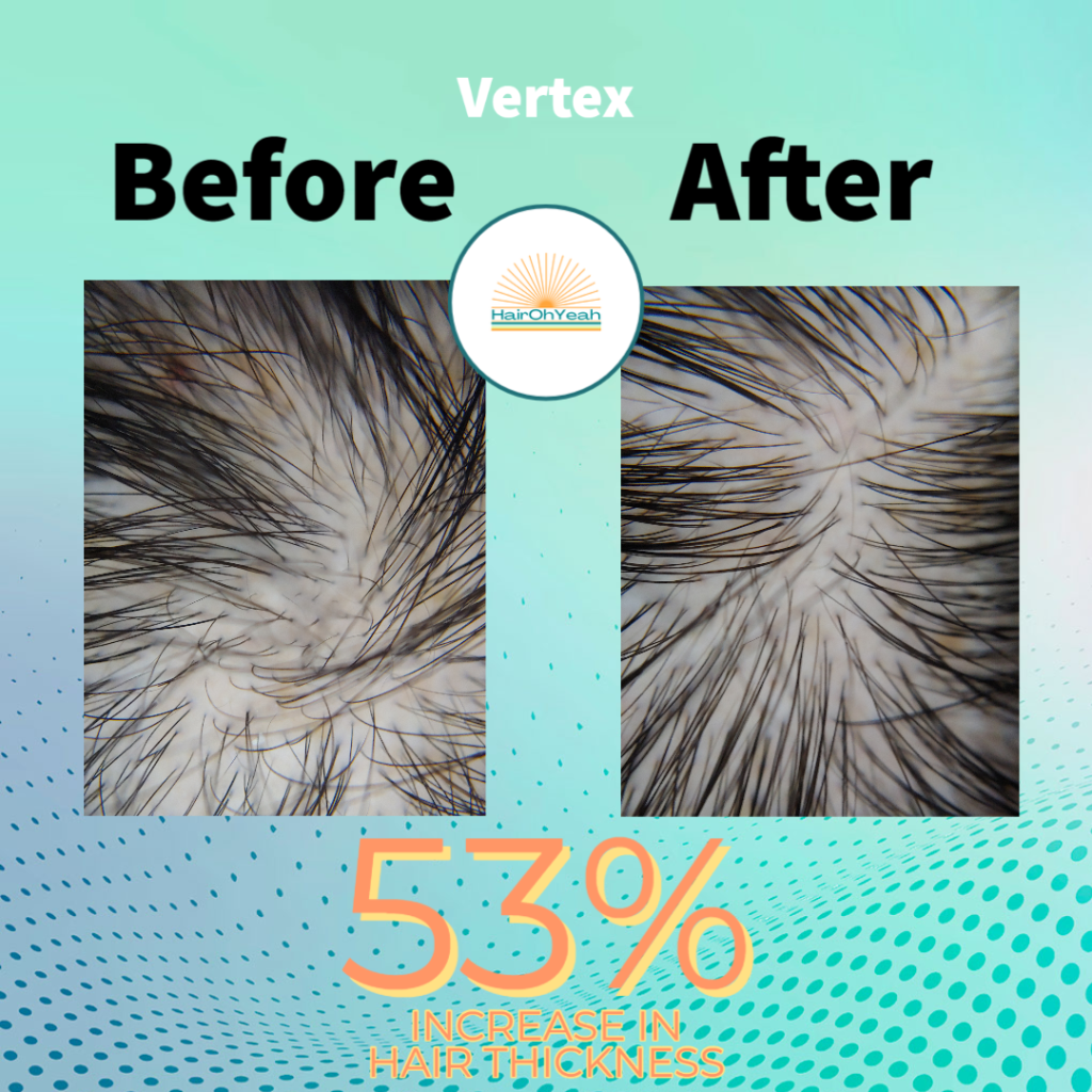Hair restoration treatments before and after . Before and after Alma Ted photos