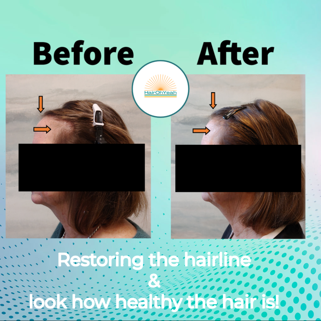 Before and After Alma Ted photos- women's hairline