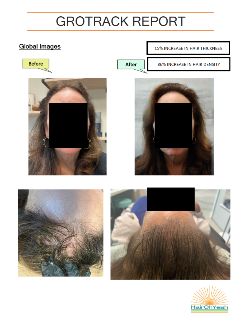 Alma Ted Before and After Hair treatment