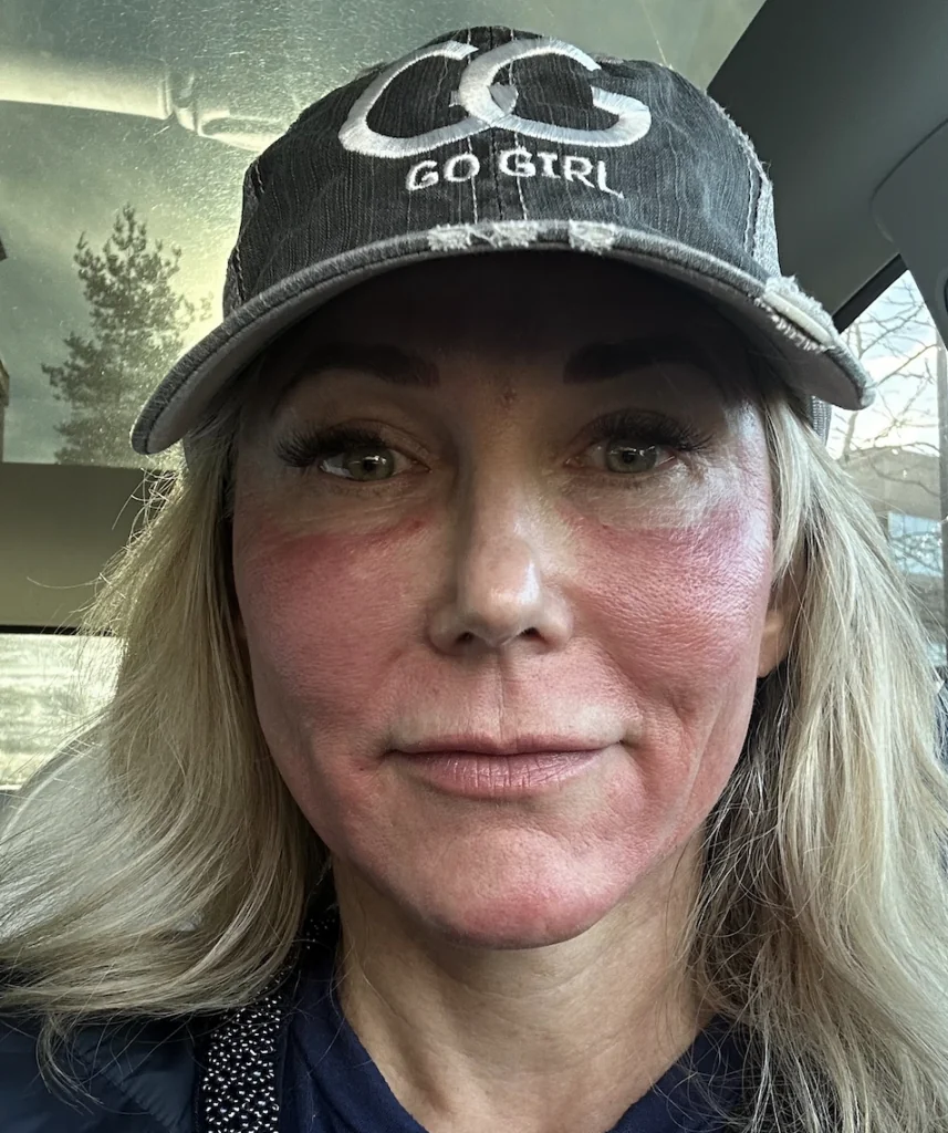 20 mins after my microneedling with exosome therapy treatment 
