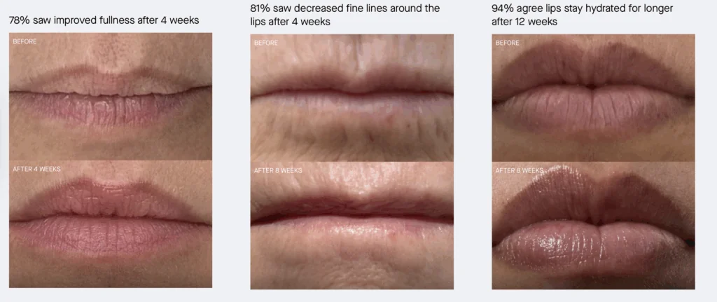 The before and after photos of using the os-o1 lip peptide 